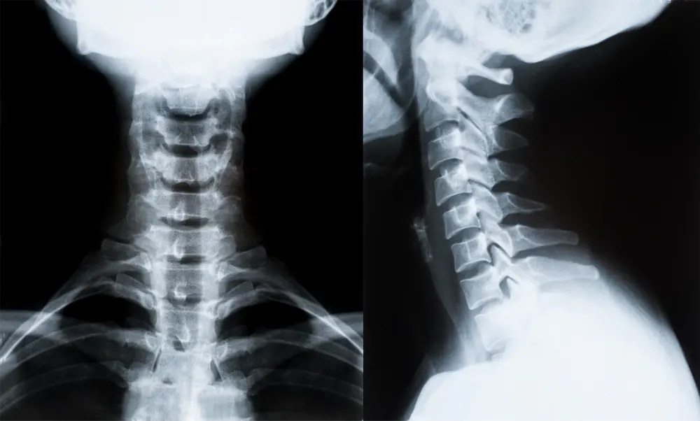 Neck x-rays NUCCA