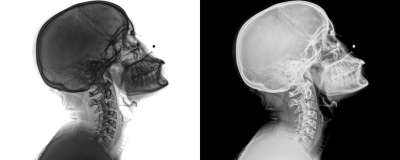 When Might Someone Consider an Upper Cervical Evaluation?