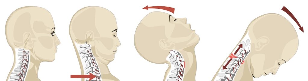 Boise Whiplash Treatment