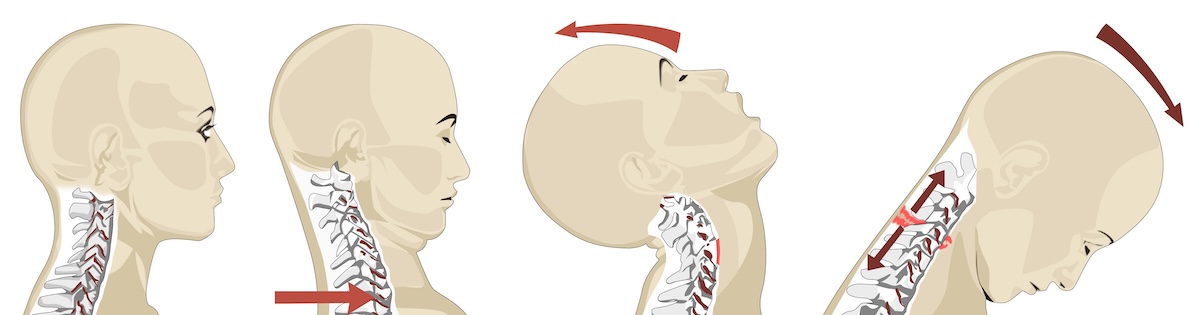 Boise Whiplash Treatment